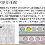 1.ADHD 児童の脳波 (8 歳)